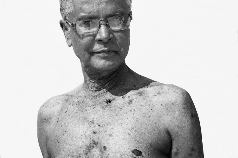 Narendranath Biswas showing recovery from arsenicosis symptoms after regularly consuming Sulabh safe drinking water from the Madhusudankati plant, North 24 Parganas district, West Bengal